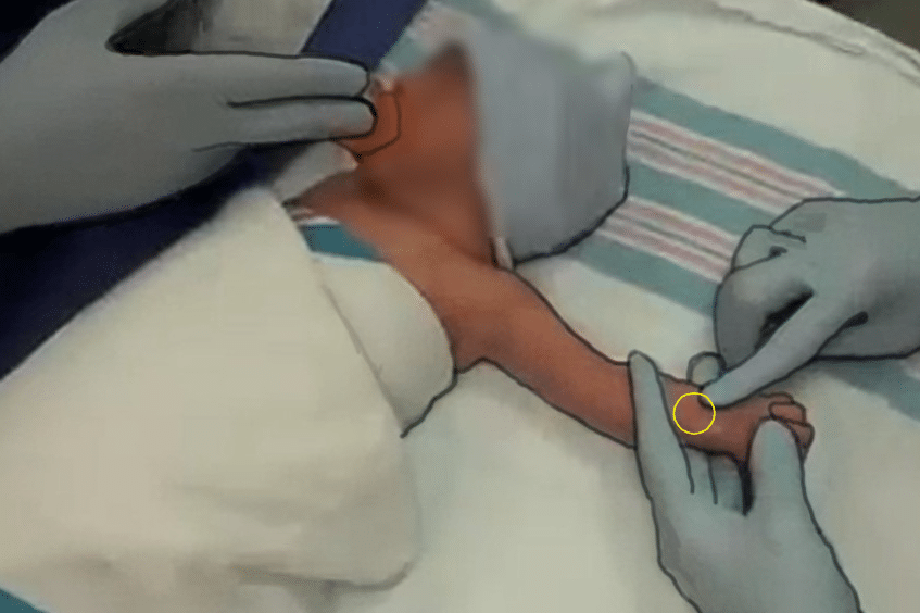 A screenshot from a virtual simulation depicting a neonatal arterial puncture procedure